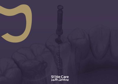 علاج جذور وأعصاب الأسنان